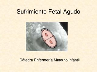 Sufrimiento Fetal Agudo