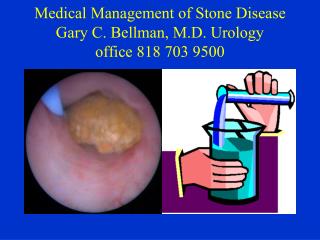 Medical Management of Stone Disease Gary C. Bellman, M.D. Urology office 818 703 9500
