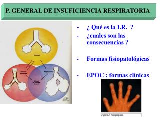 P. GENERAL DE INSUFICIENCIA RESPIRATORIA