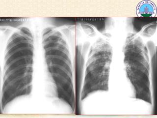 肺肿瘤 Pulmonary neoplasms