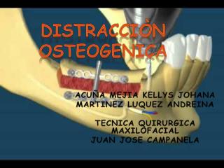 DISTRACCIÒN OSTEOGENICA