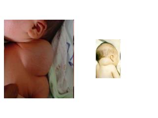 Cystic Hygroma