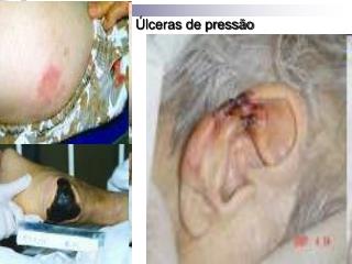 Úlceras de pressão