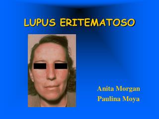 LUPUS ERITEMATOSO