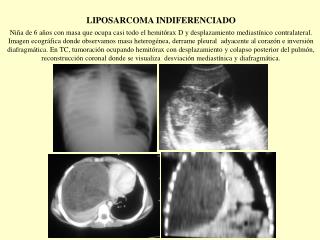 6._liposarcoma_indiferenciado