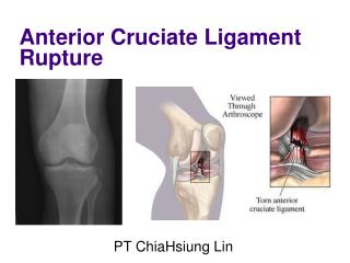 Anterior Cruciate Ligament Rupture