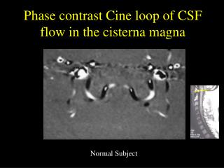 Phase contrast Cine loop of CSF flow in the cisterna magna