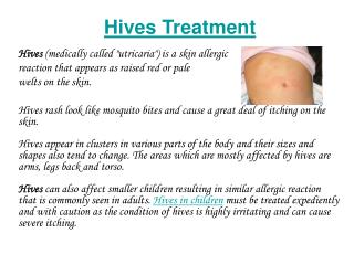 hives treatment