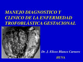 MANEJO DIAGNOSTICO Y CLINICO DE LA ENFERMEDAD TROFOBLÁSTICA GESTACIONAL