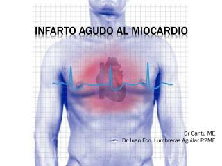 Infarto Agudo al Miocardio