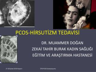 PCOS-HİRSUTİZM TEDAVİSİ