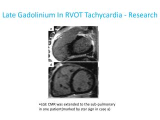 Late Gadolinium In RVOT Tachycardia - Research