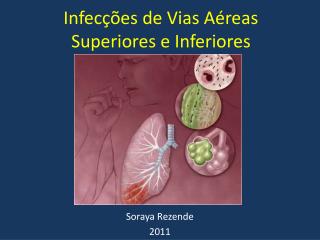 Infecções de Vias Aéreas Superiores e Inferiores