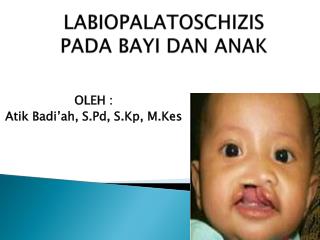 LABIOPALATOSCHIZIS PADA BAYI DAN ANAK