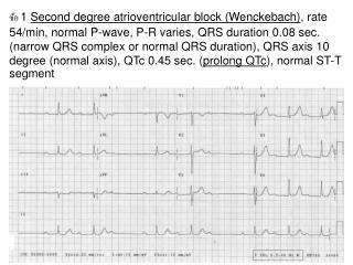 ข้อ 2 Sinus tachycardia , rate 100/min, Normal P-wave,