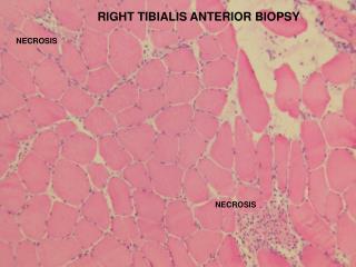 Muscle Biopsy (right TA)