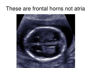 These are frontal horns not atria