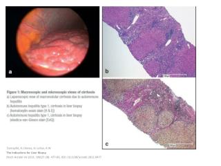 Tannapfel, A; Dienes , H; Lohse, A W The Indications for Liver Biopsy