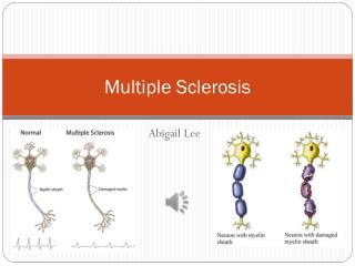 Multiple Sclerosis