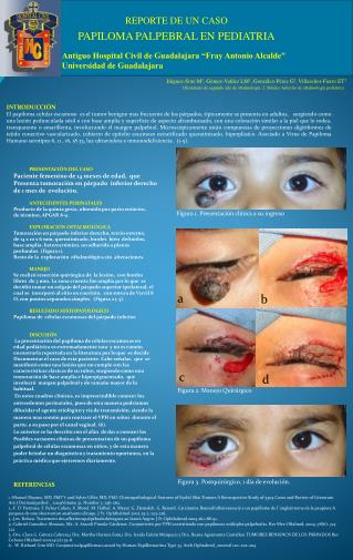 REPORTE DE UN CASO PAPILOMA PALPEBRAL EN PEDIATRIA