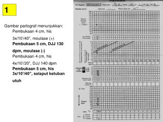 Gambar partograf menunjukkan : Pembukaan 4 cm, his 3x/10 ’/40”, moulase (+)