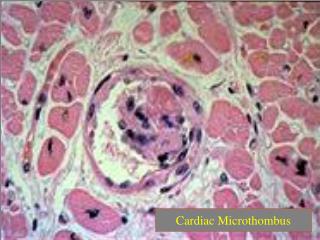 Cardiac Microthombus