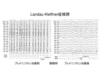 Landau-Kleffner 症候群