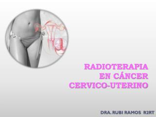 RADIOTERAPIA EN CÁNCER CERVICO-UTERINO