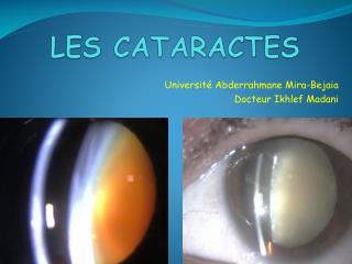 LES CATARACTES