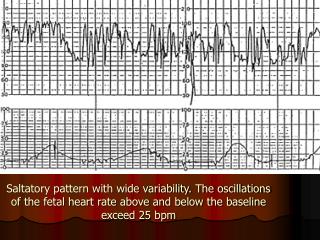 Severe variable deceleration with overshoot. However, variability is preserved.