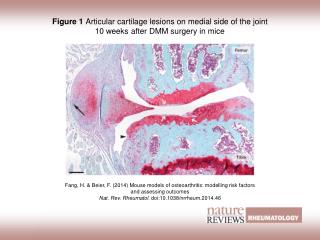 Figure 1 Articular cartilage lesions on medial side of the joint