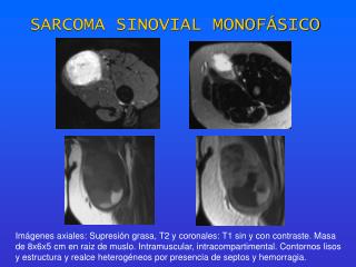 SARCOMA SINOVIAL MONOFÁSICO