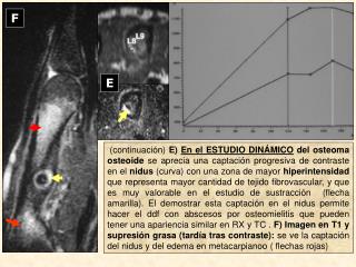 osteomaosteoidearchivo