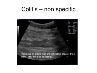 Colitis – non specific