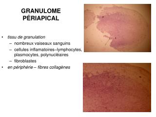 GRANULOME PÉRIAPICAL