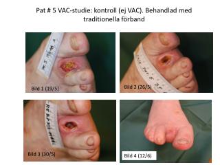 Pat # 5 VAC-studie: kontroll (ej VAC). Behandlad med traditionella förband