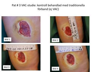 Pat # 3 VAC-studie: kontroll behandlad med traditionella förband (ej VAC)