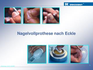 Nagelvollprothese nach Eckle