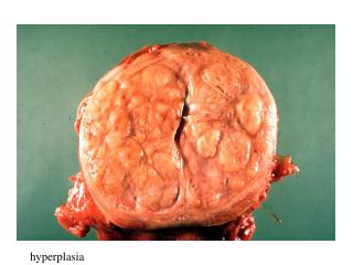 hyperplasia