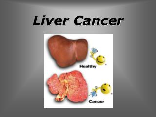 Liver Cancer