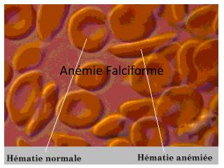 Anémie Falciforme