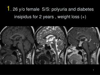 1 . 26 y/o female S/S: polyuria and diabetes insipidus for 2 years , weight loss (+)