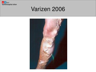 Varizen 2006