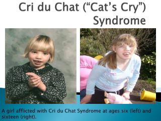Cri du Chat (“Cat’s Cry”) Syndrome