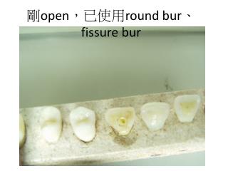 剛 open ，已使用 round bur 、 fissure bur