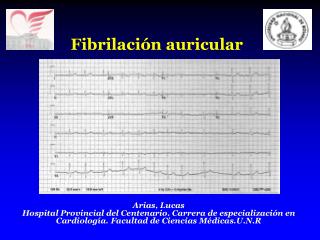 Fibrilación auricular