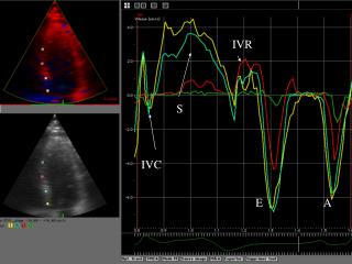 IVC