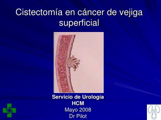 Cistectomía en cáncer de vejiga superficial