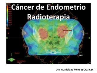 Cáncer de Endometrio Radioterapia