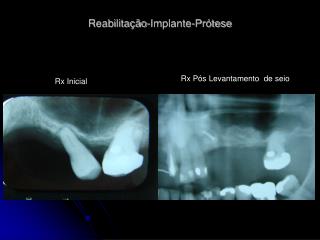 Reabilitação-Implante-Prótese